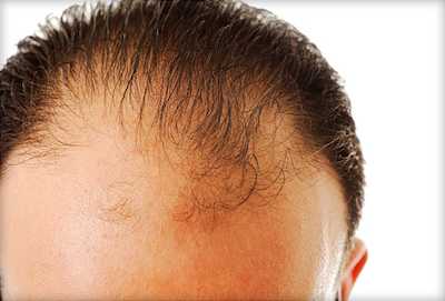 Hair Loss and Stem Cell Therapy