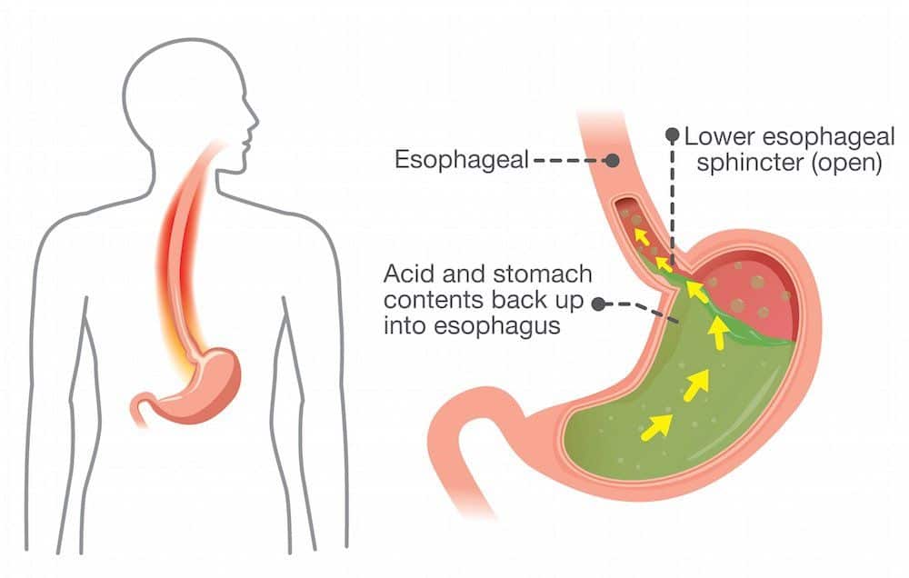 what-is-gerd-how-to-treat-heartburn